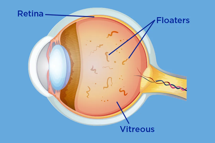 Eye Floaters Eye Floaters Image