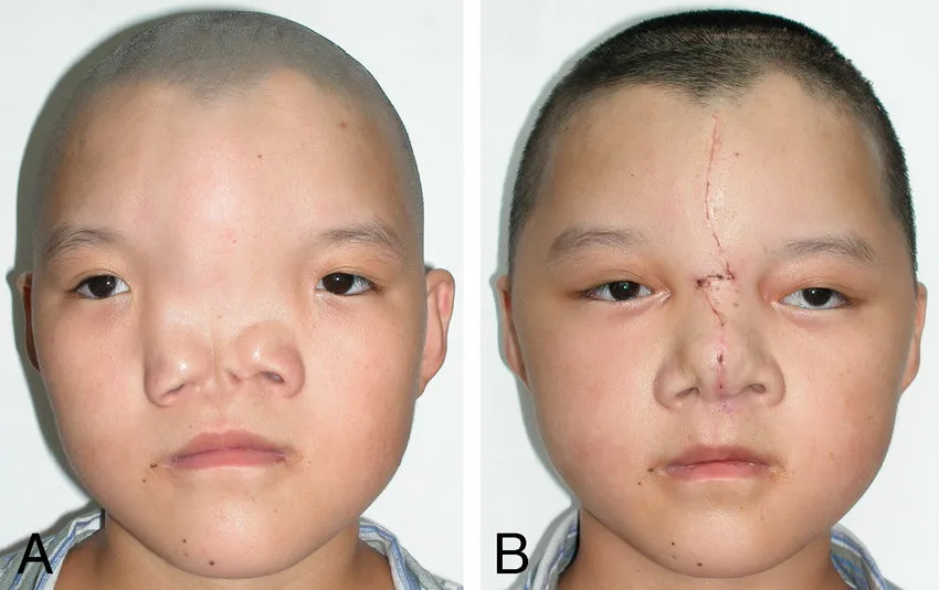 Orbital Hypertelorism Causes Prevention Treatment Tender Palm Eye 