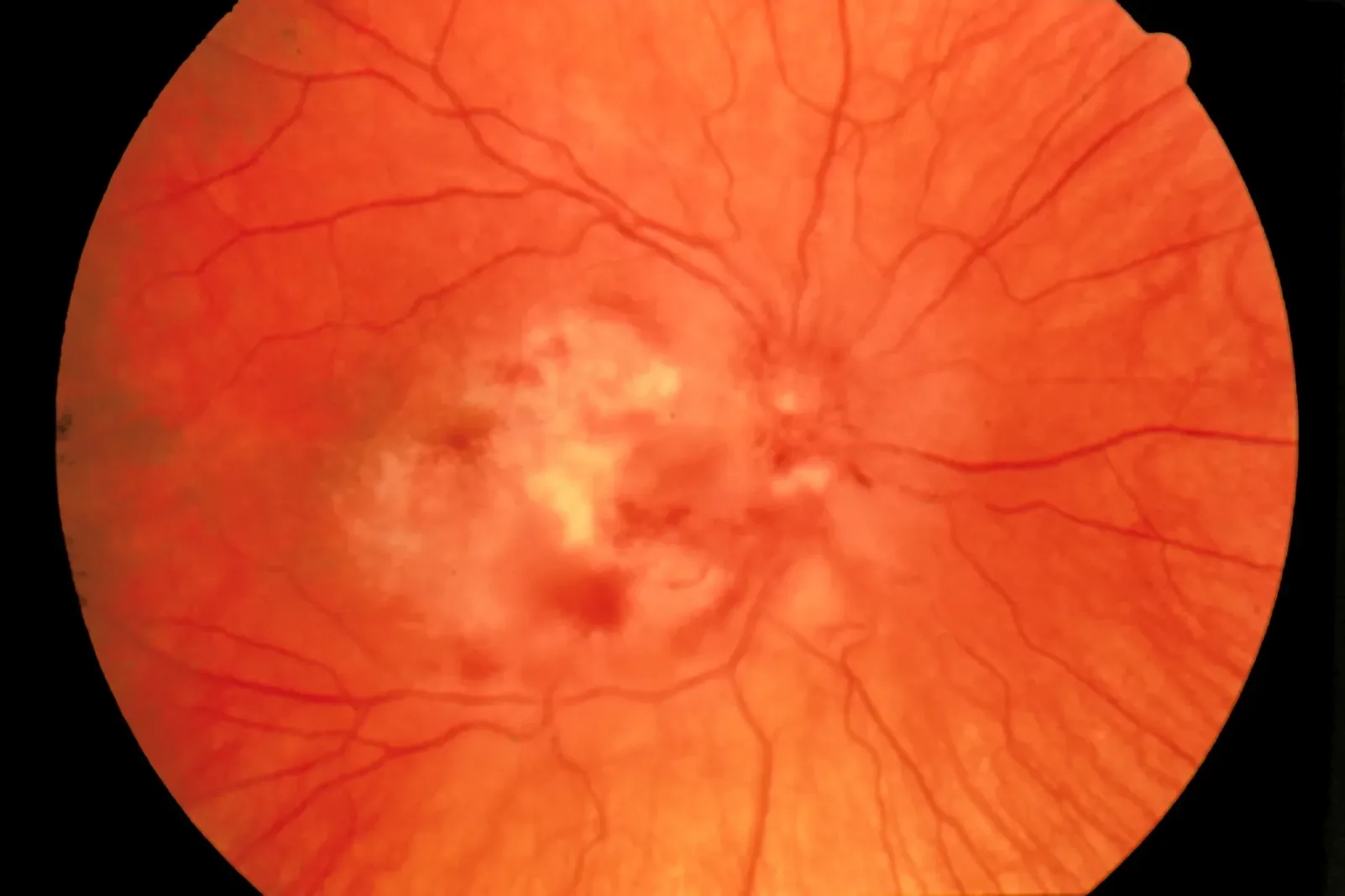 Cytomegalovirus (CMV) Retinitis
